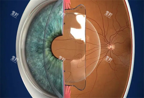 晶体植入 晶体植入