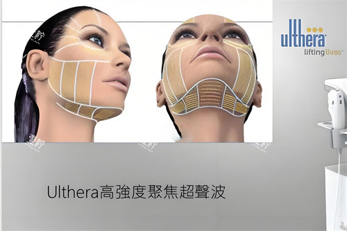 ulthera*** ulthera***