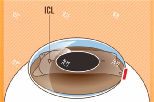 ICL晶体植入后示意图