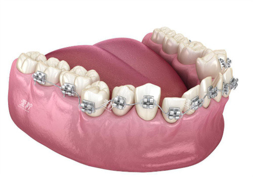 金属牙齿矫正展示图