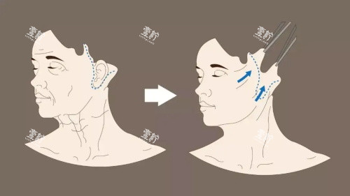 拉皮示意图 拉皮示意图