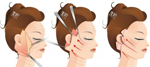 拉皮手术过程图 拉皮手术过程图