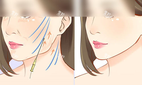 拉皮手术成效示意图 拉皮手术成效示意图