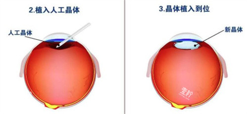 植入人工晶体