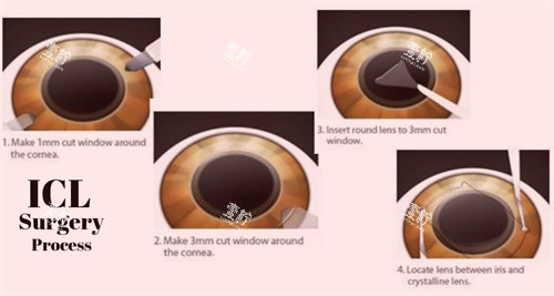晶体植入手术过程细节图