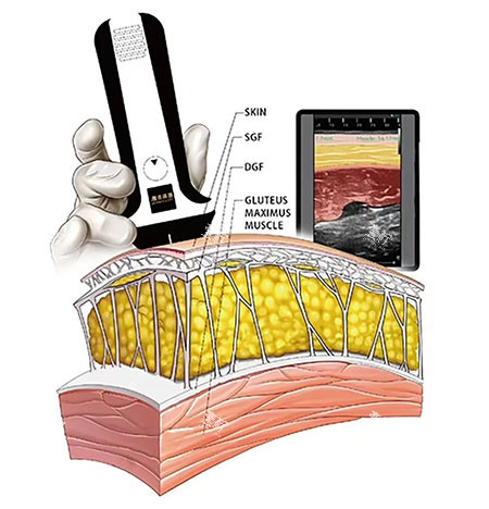 维密金雕原理示意图