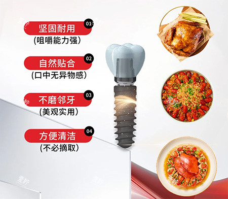 安特种植牙特色优点.jpg