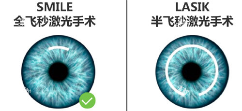 半飞秒和全飞秒手术区别图.jpg