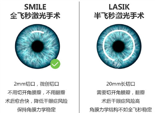 全飞秒与半飞秒手术对比图.jpg