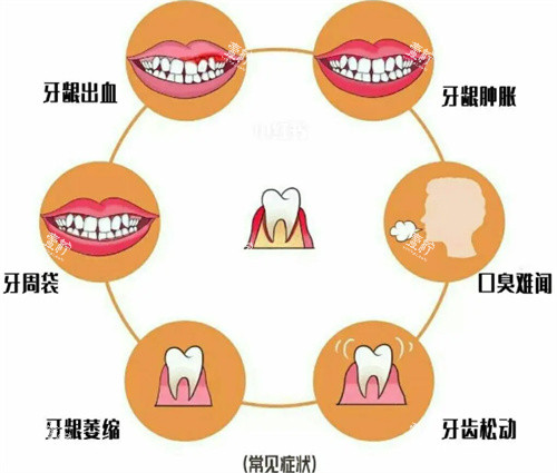 牙周疾病照片.jpg