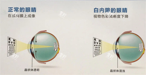 白内障的眼睛示意图.jpg