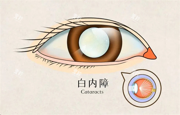 白内障怎么办.jpg