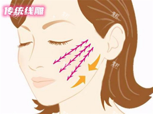 苹果肌线雕提升术动画演示图.jpg