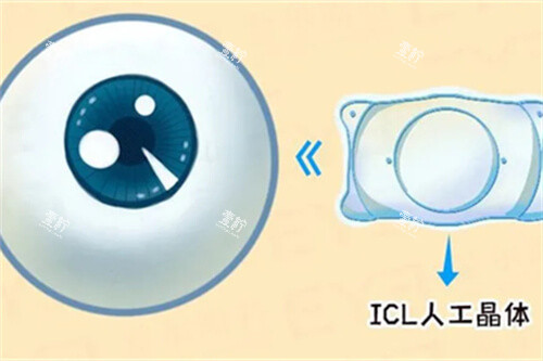 icl人工晶体与眼球漫画图.jpg icl人工晶体与眼球漫画图.jpg