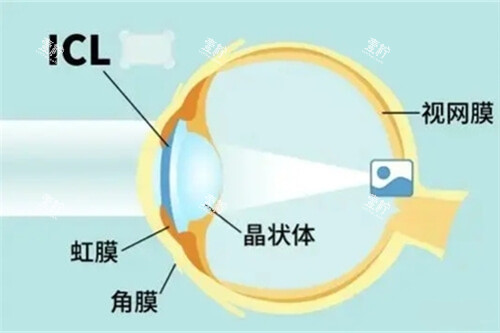 icl晶体植入术眼睛位置示意图.jpg icl晶体植入术眼睛位置示意图.jpg