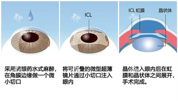 icl晶体植入手术方法.jpg icl晶体植入手术方法.jpg