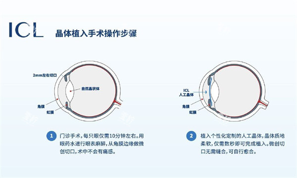icl晶体植入解刨图.jpg icl晶体植入解刨图.jpg