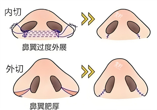鼻翼缩小内切外切对比.jpg 鼻翼缩小内切外切对比.jpg