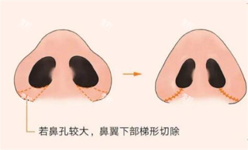 鼻翼缩小手术操作.jpg 鼻翼缩小手术操作.jpg
