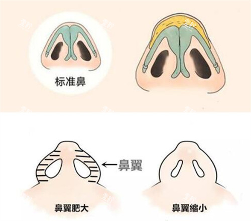 鼻翼缩小改善展示图.jpg 鼻翼缩小改善展示图.jpg