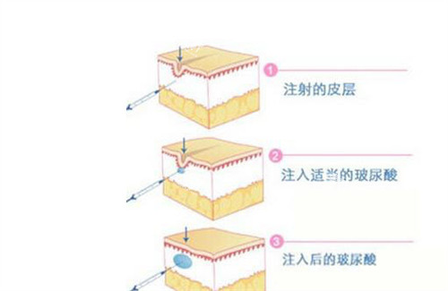 玻尿酸填充原理动画演示图.jpg