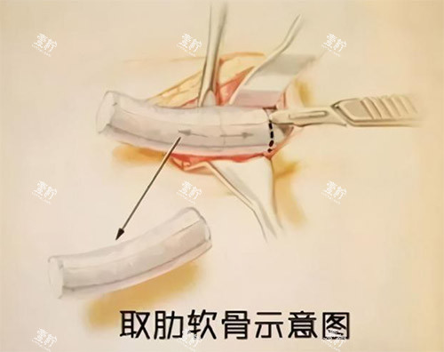 肋骨鼻手术过程图.jpg