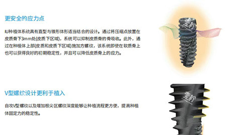 沃兰种植牙2980元起，这个低价会不会影响效果和使用寿命？
