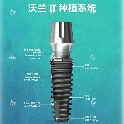韩国沃兰种植体.jpeg 韩国沃兰种植体.jpeg