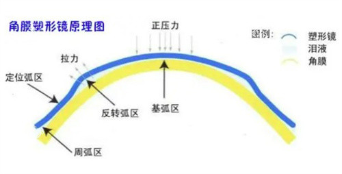 角膜塑形镜原理示意图.jpg 角膜塑形镜原理示意图.jpg