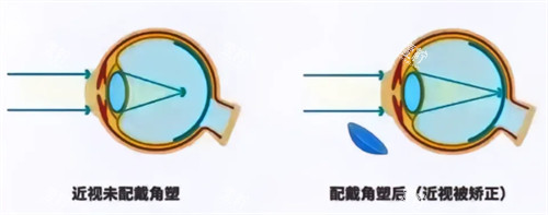 角膜塑形镜前后.jpg 角膜塑形镜前后.jpg