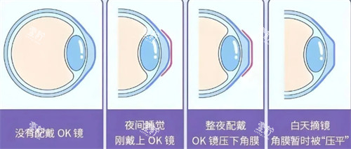 角膜塑形镜佩戴前后对比图.jpg 角膜塑形镜佩戴前后对比图.jpg