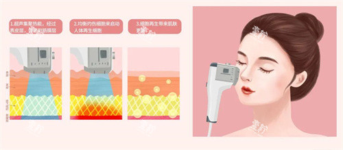超声炮.jpg 超声炮.jpg