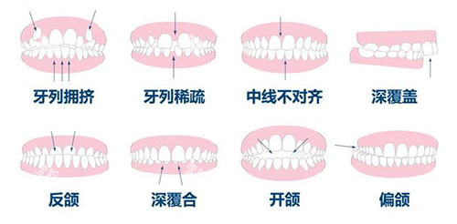 牙齿矫正正畸适应症.jpg 牙齿矫正正畸适应症.jpg