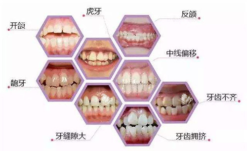牙齿矫正适应症展示图.jpg 牙齿矫正适应症展示图.jpg