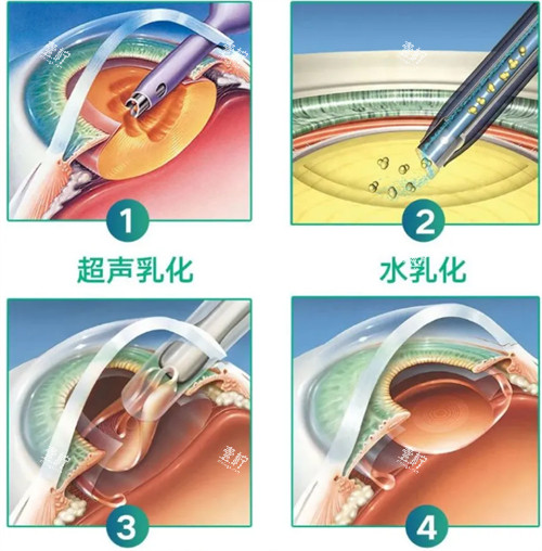 超声乳化白内障手术过程.jpg 超声乳化白内障手术过程.jpg