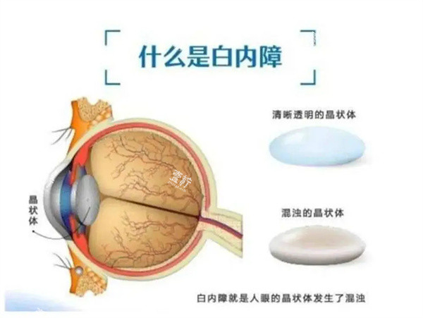 什么是白内障.jpg 什么是白内障.jpg