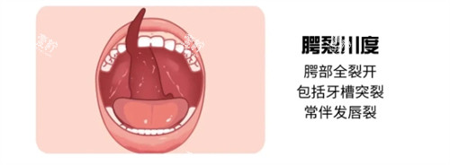 三度唇腭裂 三度唇腭裂