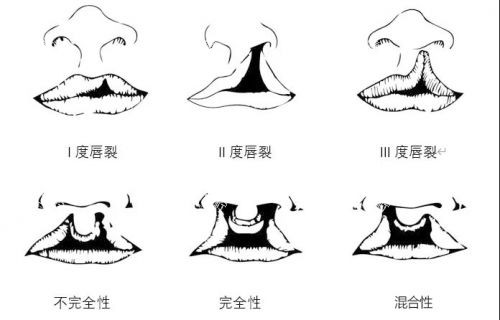 唇腭裂图片) 唇腭裂图片)