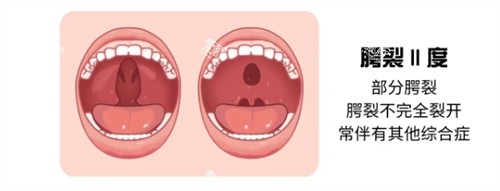 二度唇腭裂 二度唇腭裂