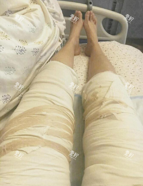 大腿吸脂照片.jpg