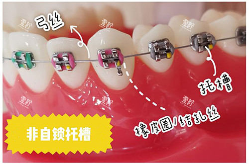 牙齿矫正非自锁托槽.jpg 牙齿矫正非自锁托槽.jpg
