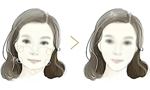 面部吸脂对比.jpg 面部吸脂对比.jpg