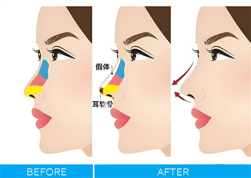 隆鼻手术图解动画图.jpg 隆鼻手术图解动画图.jpg