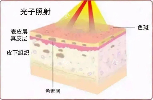 光子嫩肤原理卡通示意图.jpg