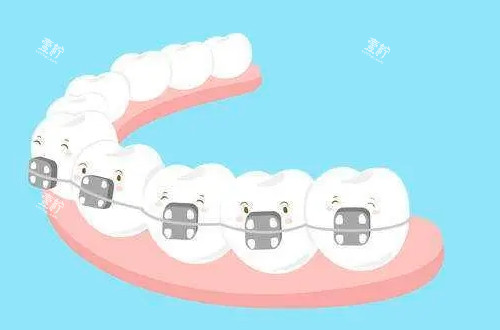 传统牙齿矫正器动画展示图.png 传统牙齿矫正器动画展示图.png
