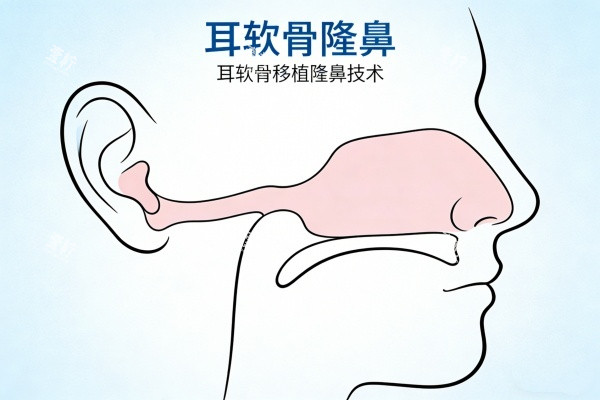 耳软骨隆鼻卡通图一览.jpg