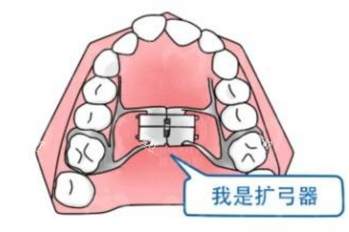 正畸扩弓示意图.jpg