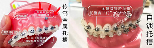 牙齿矫正牙套对比实物展示图.jpg