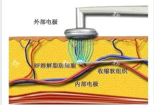 黄金微雕原理.png