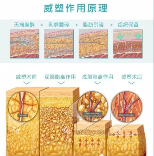 郑州美时美刻吸脂多少钱？这价靠谱吗，有没有隐形消费或者额外费用